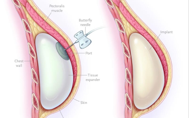 Breast Reconstruction